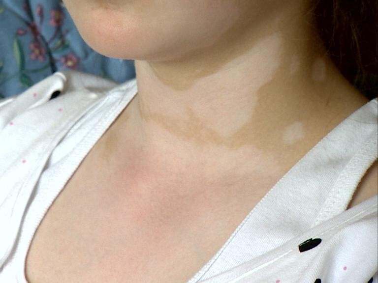 Bielactwo – zmiany skórne