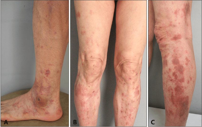 Capillaritis – zmiany naczyniowe na nogach