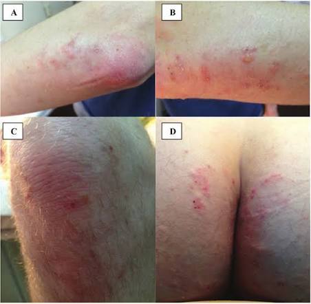 Dermatitis herpetiformis – opryszczkowe zapalenie skóry