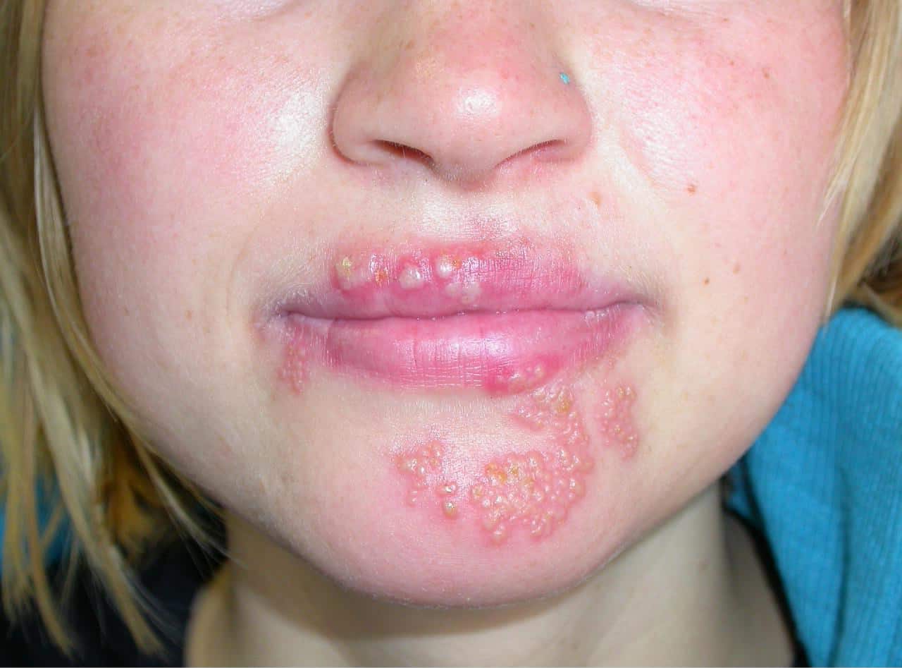 Gronkowiec złocisty – zmiany skórne