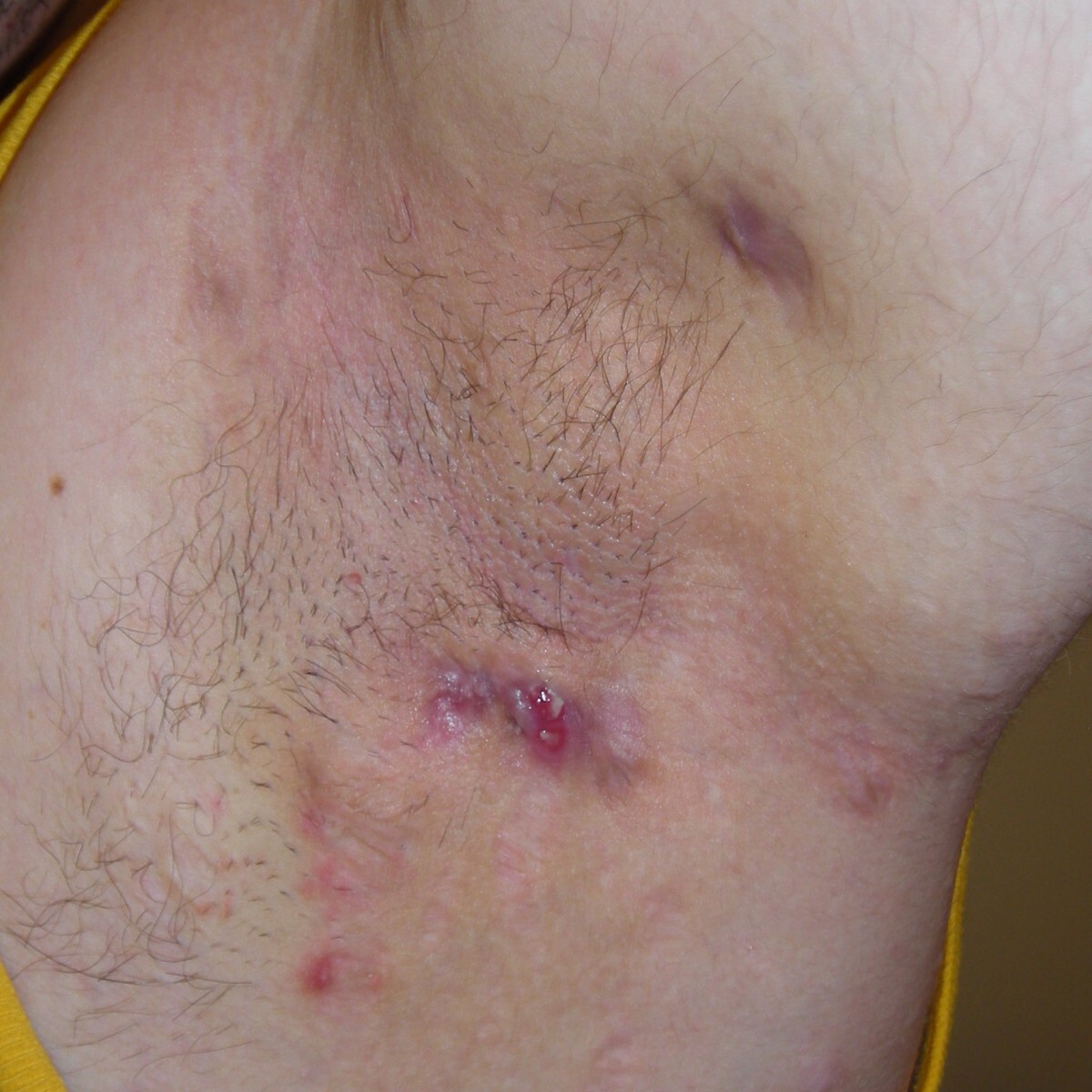 Hidradenitis Suppurativa – zmiany skórne