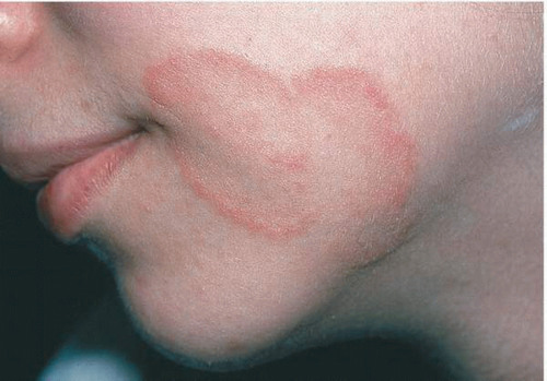 Liszaj płaski – zmiany skórne