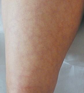 Livedo reticularis – siatkowatość skóry