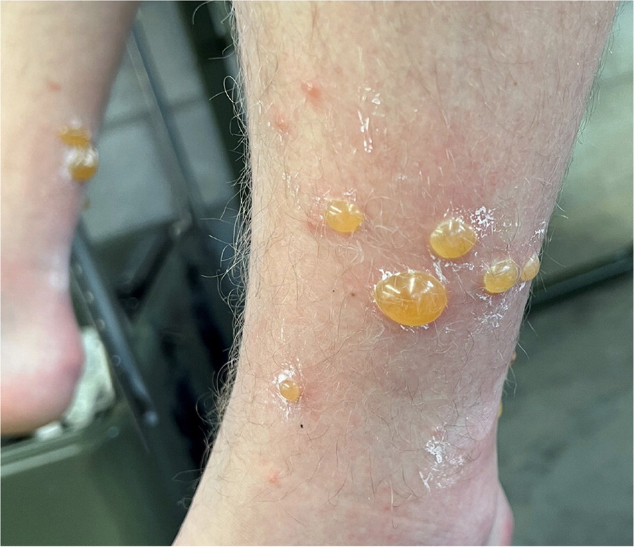 Pemfigoid – zmiany skórne