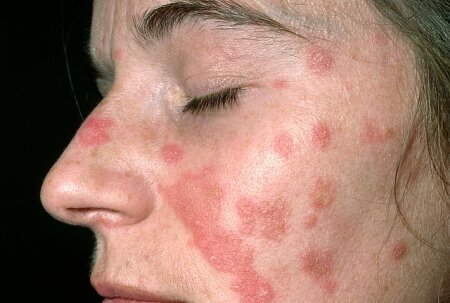 Sarkoidoza – zmiany skórne