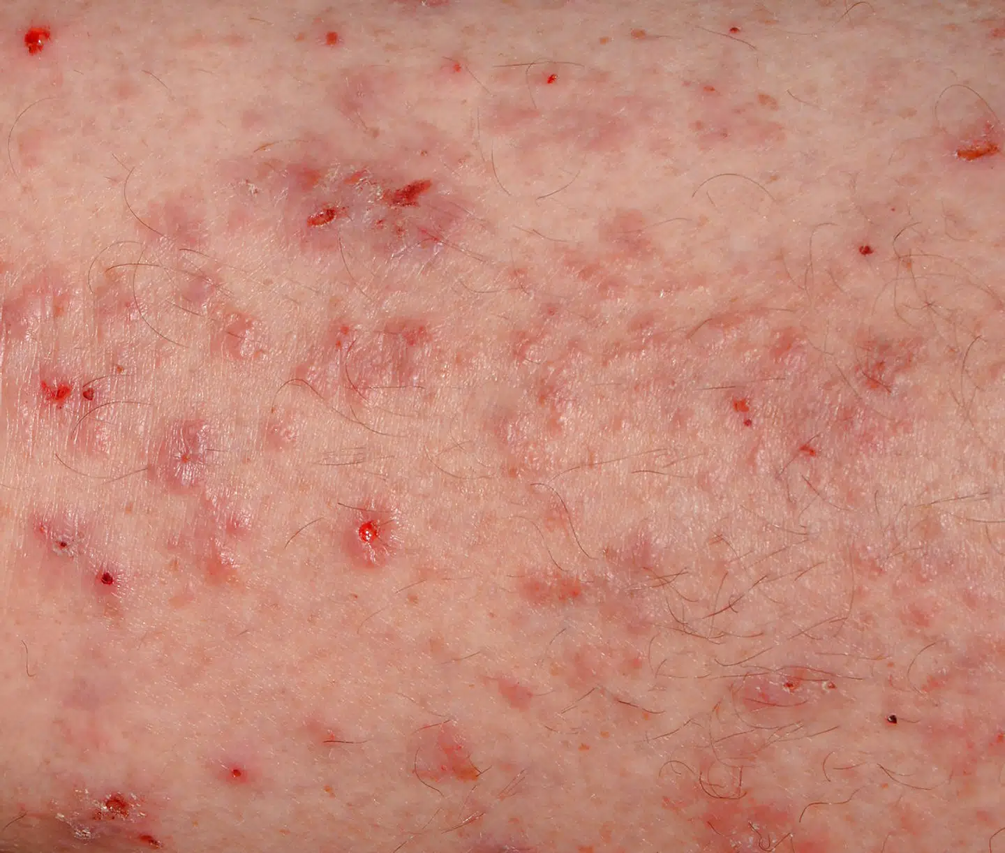Świerzb – zmiany skórne