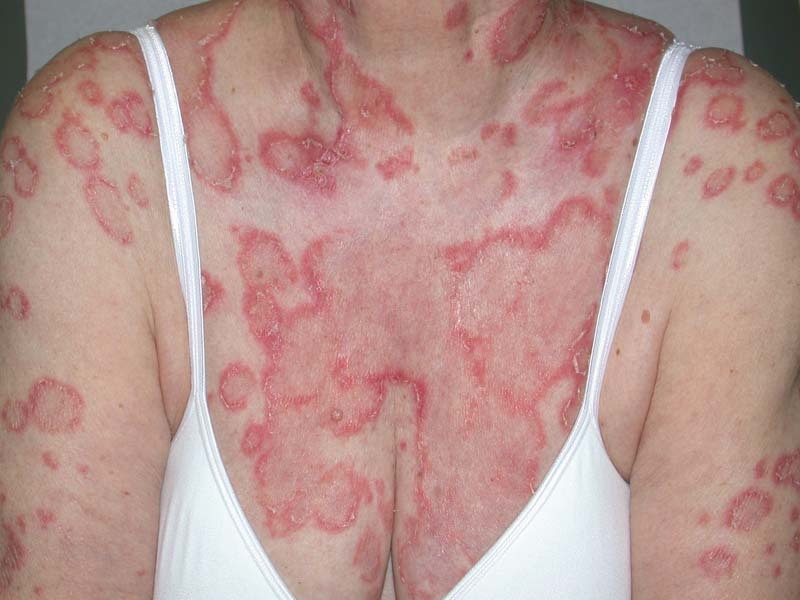 Toczeń rumieniowaty – zmiany skórne