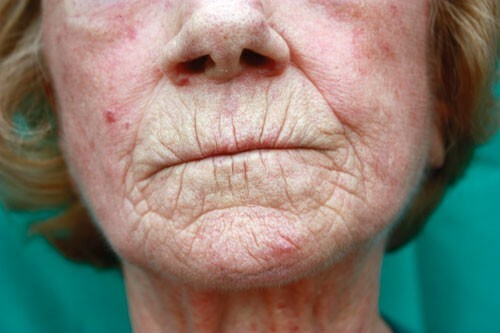 Twardzina układowa – zmiany skórne