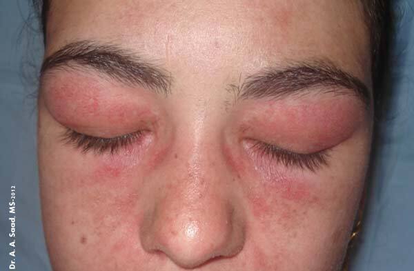 Zapalenie skórno-mięśniowe – zmiany skórne